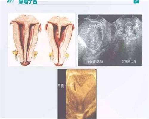 子宫腺肌症试管成功率_有生理缺陷或疾病不能生育的助孕希望_上海专业指导